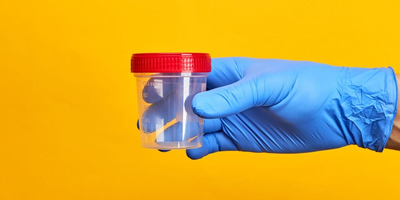 Urine Cell-Free DNA Test Shows Promise for Bladder Cancer Diagnosis