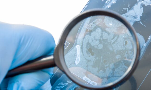 PathAI Launches AI Tools for Inflammatory Bowel Disease Clinical Trials