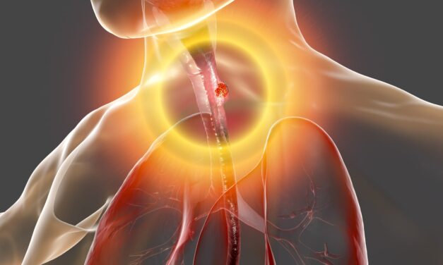 FDA-Approved PD-L1 Companion Diagnostic Expanded to Esophageal and GEJ Carcinoma