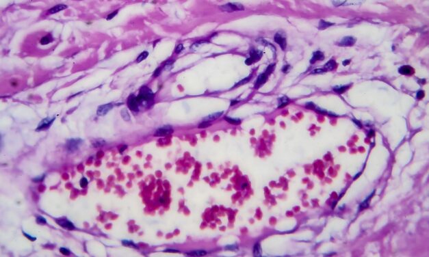 CSF Liquid Biopsy Delivers 82% Clinical Impact Rate in CNS Lymphoma Cases