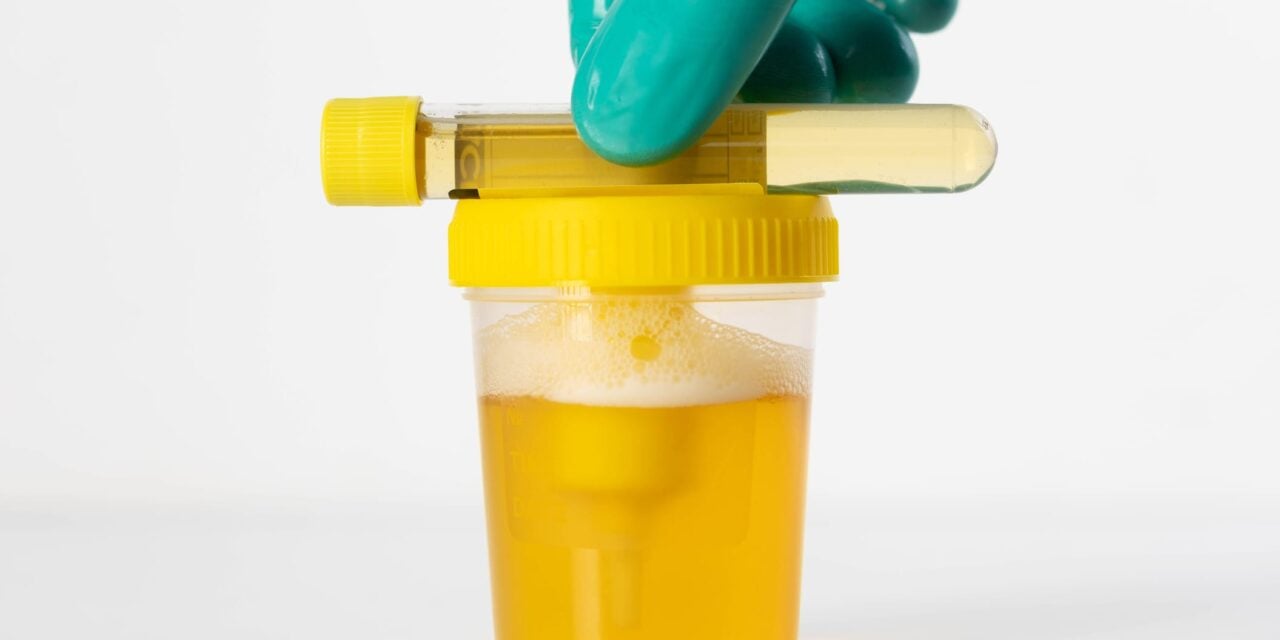 EpiCapture Urine-Based Prostate Cancer Test Shows High Accuracy in Clinical Study