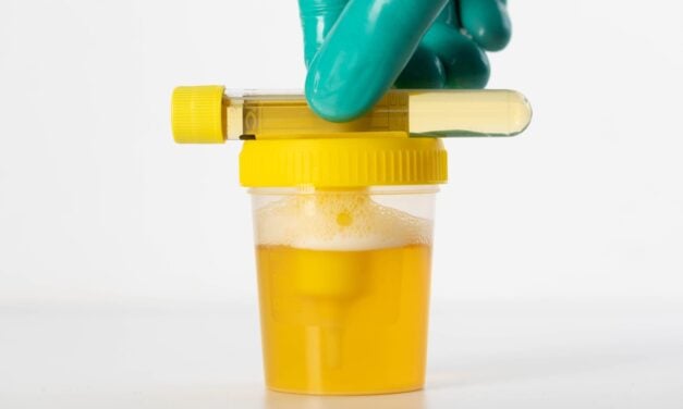 EpiCapture Urine-Based Prostate Cancer Test Shows High Accuracy in Clinical Study