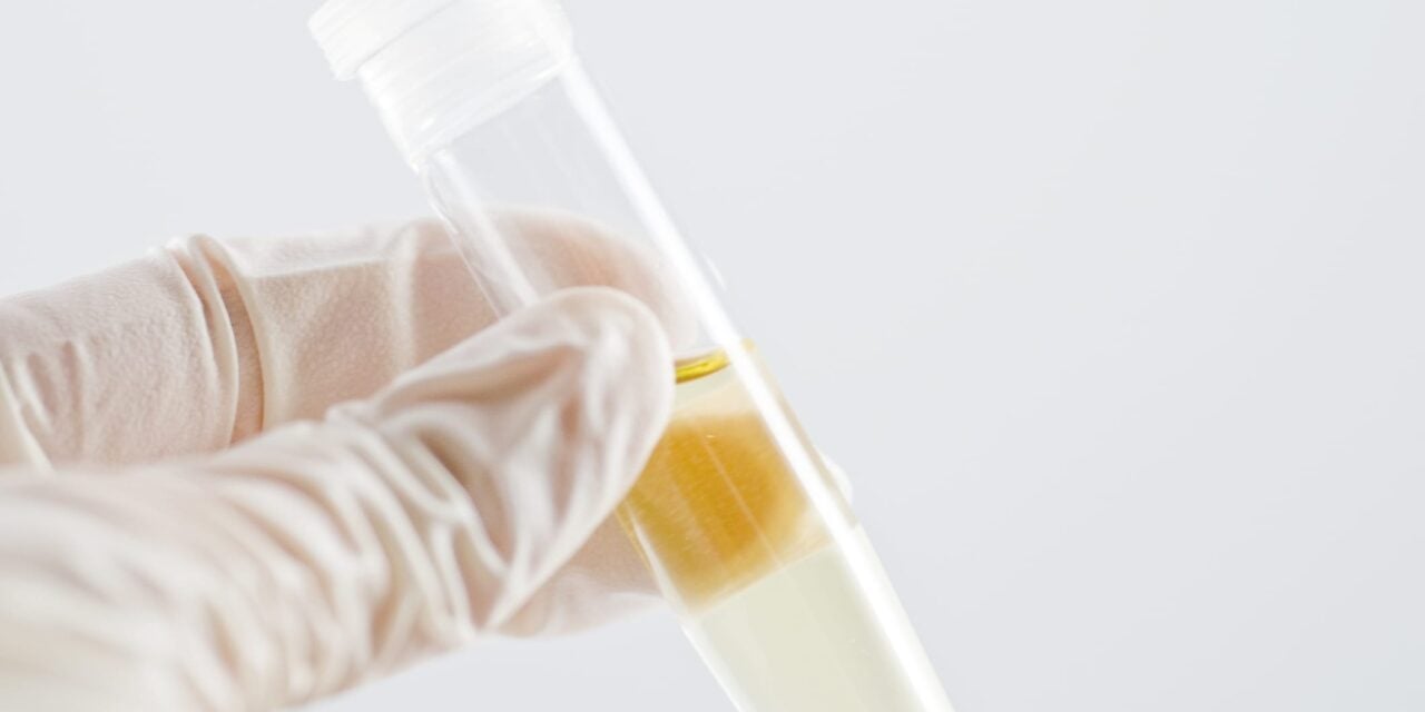 FDA Grants Breakthrough Designation to Urine-Based Alzheimer’s Test