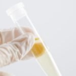 FDA Grants Breakthrough Designation to Urine-Based Alzheimer’s Test