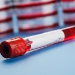 Blood Test for Colon Cancer Improves Chemotherapy Decisions, Study Finds