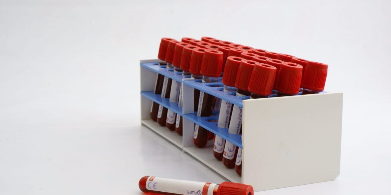 Can a Blood Test Identify Head and Neck Cancer Patients at Risk of Recurrence?