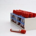 Can a Blood Test Identify Head and Neck Cancer Patients at Risk of Recurrence?