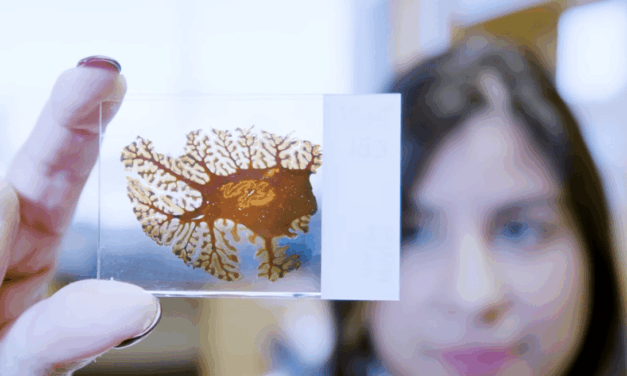 Could a Blood Test  Predict Risk of Brain Swelling During Alzheimer’s Treatment?