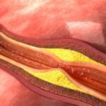 New Method Simplifies Testing of HDL Function in Heart Disease Study