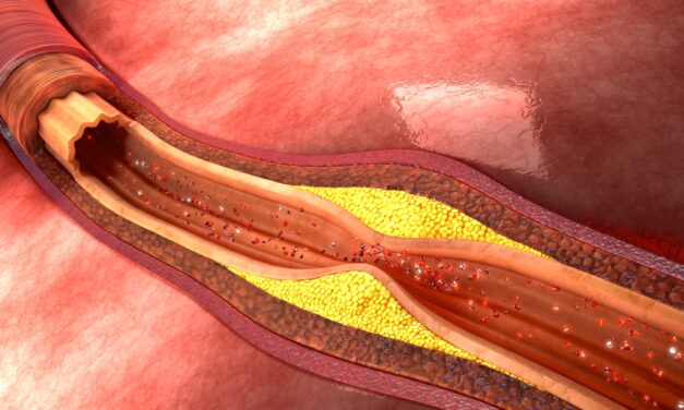 New Method Simplifies Testing of HDL Function in Heart Disease Study