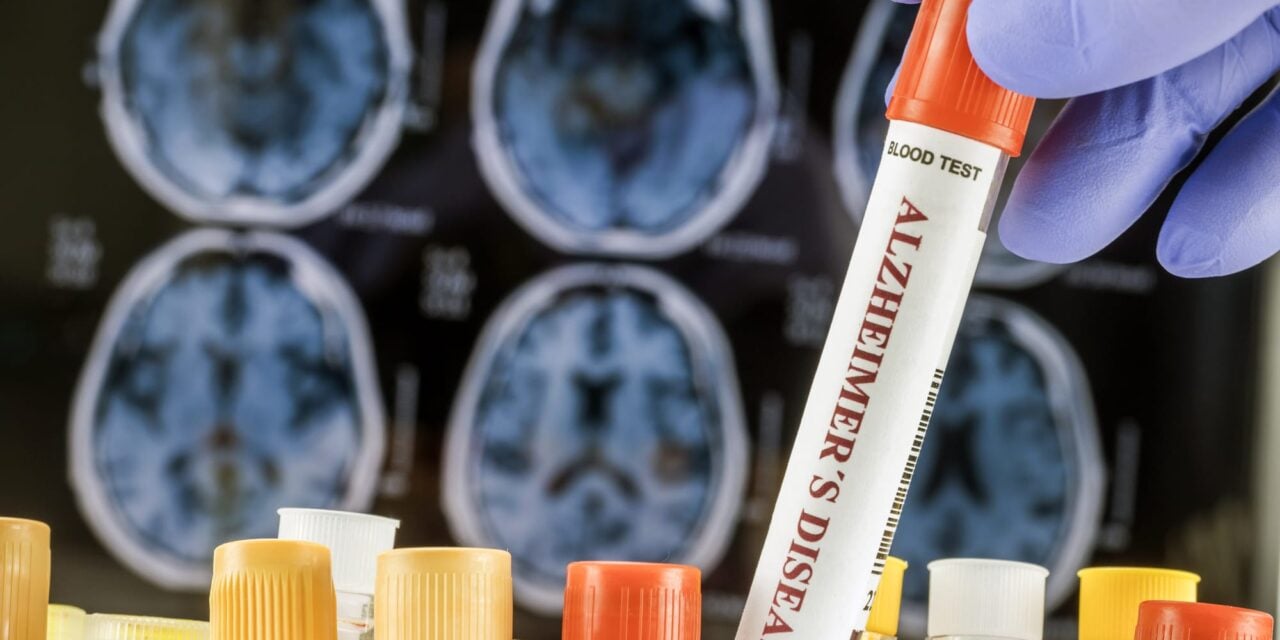 First Commercial Alzheimer’s Tau Tangle Blood Test Launches