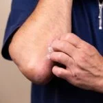 New York State Approves Castle Biosciences’ Gene Expression Test to Guide Atopic Dermatitis Treatment