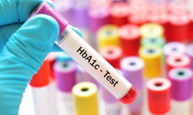 Immunoassays May Underestimate HbA1c in Patients with Sickle Cell Trait