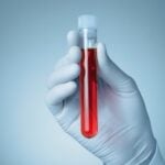 Lilly to Present Data Comparing P-Tau217 Blood Tests With Amyloid PET at AAIC