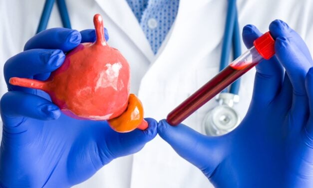 Blood Test Detects Aggressive Prostate Cancer More Accurately Than PSA in Large Study