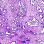 Artificial Intelligence Improves Accuracy, Efficiency in Prostate Biopsy Review