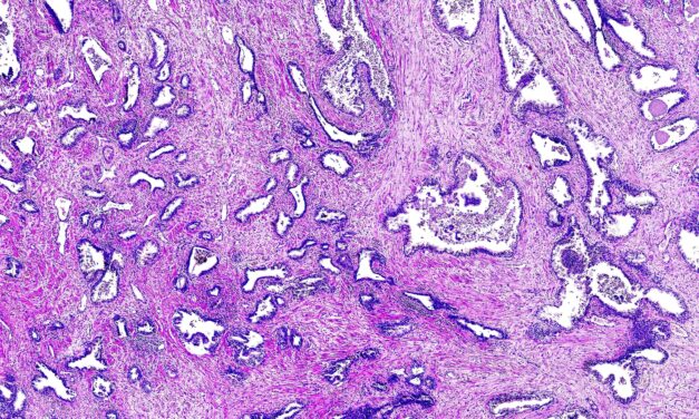 Artificial Intelligence Improves Accuracy, Efficiency in Prostate Biopsy Review