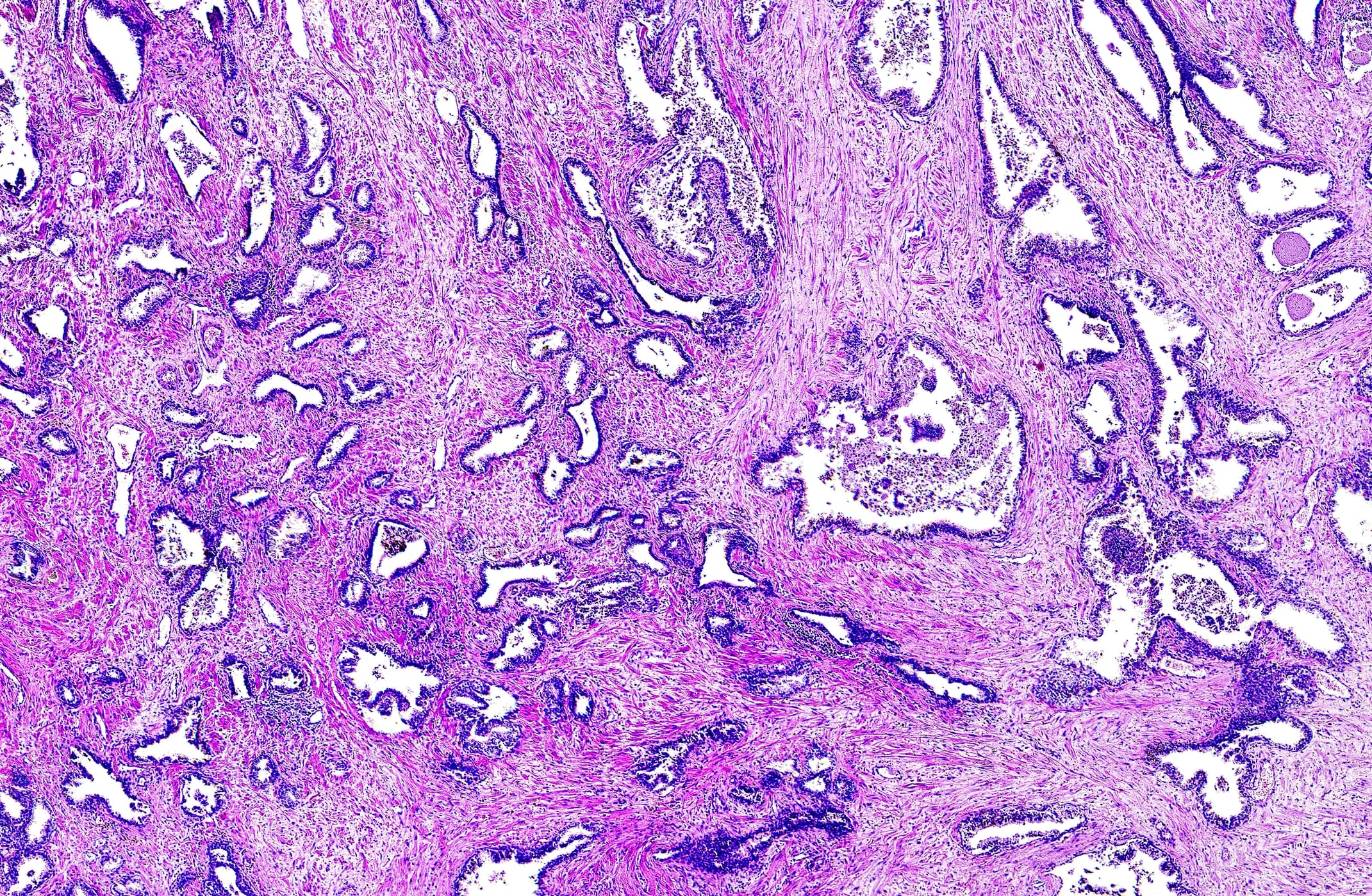 Artificial Intelligence Improves Accuracy, Efficiency in Prostate Biopsy Review
