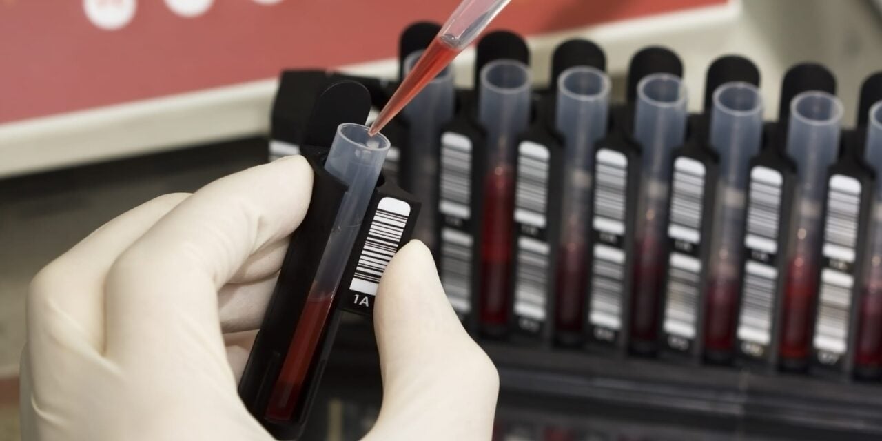 Analysis Shows Blood RNA Test Improves Breast Cancer Screening Outcomes and Cost-Effectiveness