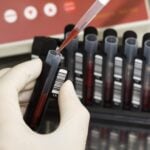 Analysis Shows Blood RNA Test Improves Breast Cancer Screening Outcomes and Cost-Effectiveness