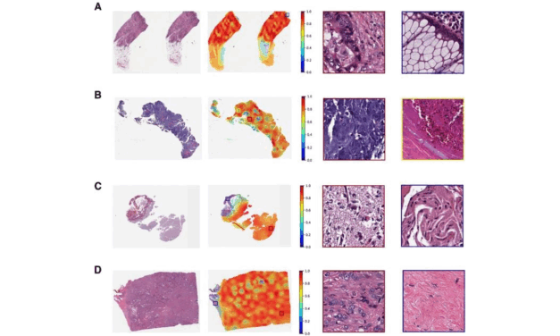 AI Model Predicts Gene Mutations and Biomarkers Across 32 Cancer Types