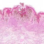 FDA Approves Labcorp Companion Diagnostic for Advanced Melanoma