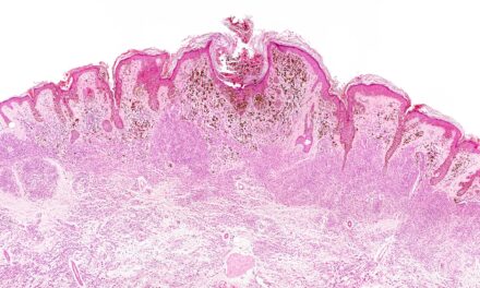FDA Approves Labcorp Companion Diagnostic for Advanced Melanoma