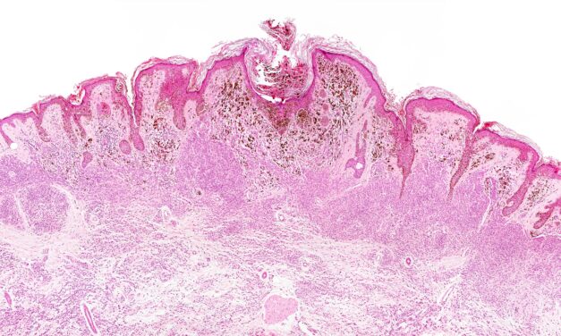 FDA Approves Labcorp Companion Diagnostic for Advanced Melanoma