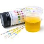 Urine Biomarker Test Improves Prediction of Donor Kidney Outcomes