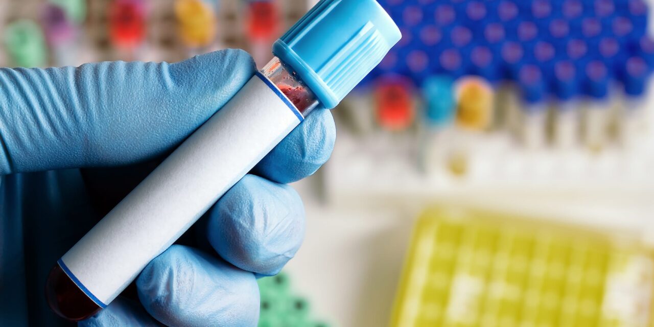 Siemens Healthineers Launches FDA-Cleared D-Dimer Blood Test
