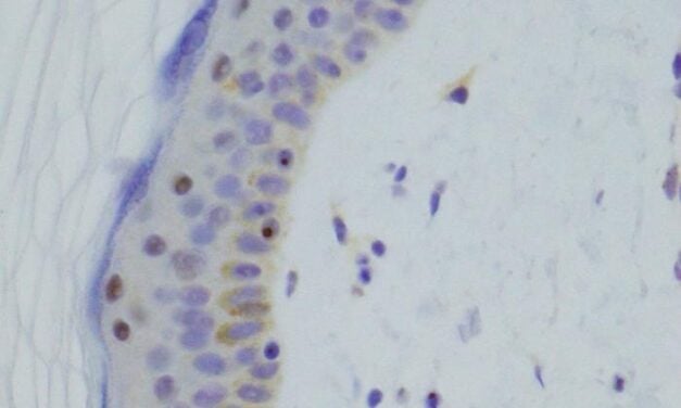 DNA Test Diagnoses Inherited Muscle Diseases Missed by Standard Testing