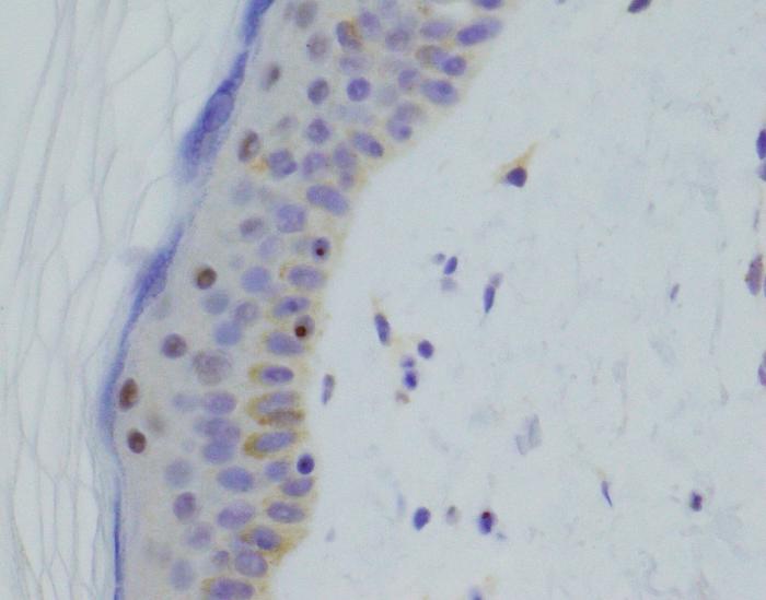 DNA Test Diagnoses Inherited Muscle Diseases Missed by Standard Testing