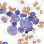 OGT Launches NGS Panel to Detect Residual Disease in Acute Myeloid Leukemia