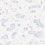 Roche Launches Test for differential Diagnosis of Mesothelioma