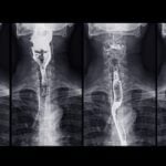 TissueCypher Shifts Care Decisions in Barrett’s Esophagus Study