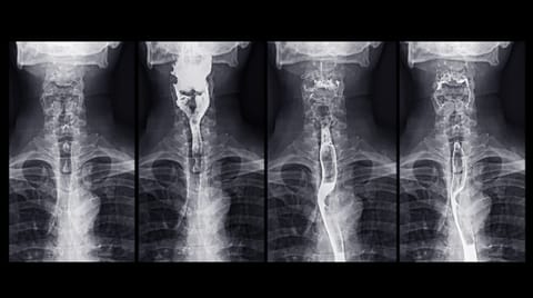 TissueCypher Shifts Care Decisions in Barrett’s Esophagus Study