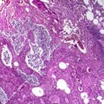 AI Analysis of Pathology Slides Shows Promise for Guiding Lung Cancer Biomarker Testing