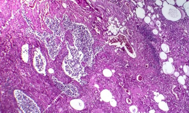 AI Analysis of Pathology Slides Shows Promise for Guiding Lung Cancer Biomarker Testing