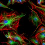 Study Shows Skin Biopsies Can Help Diagnose Mitochondrial Disease